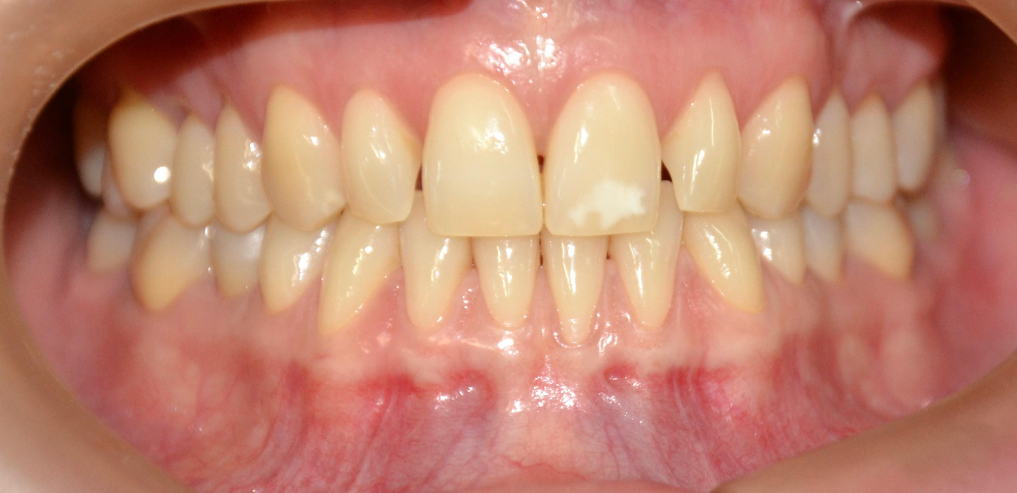 Antes — Clareamento Dental