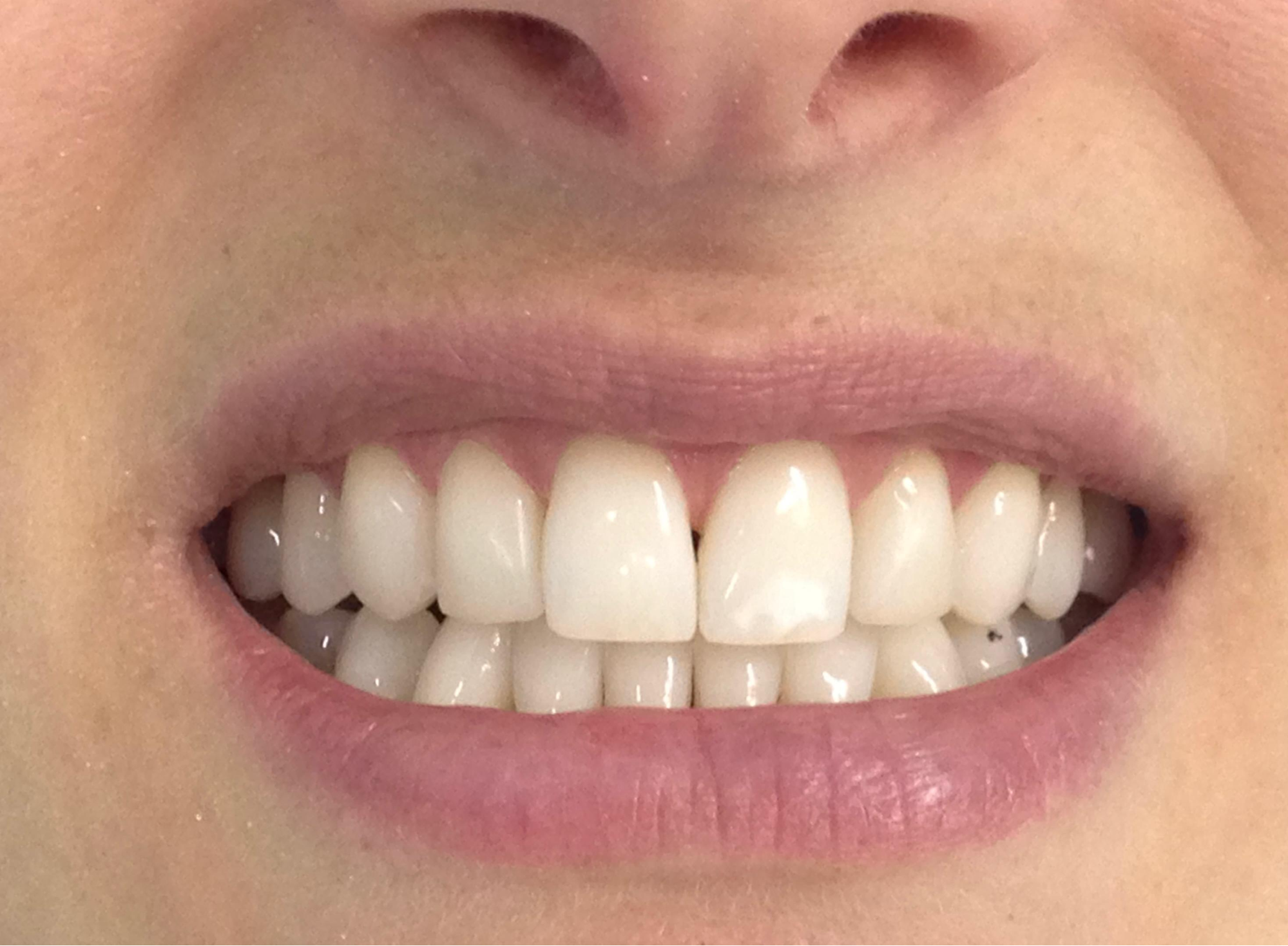 Depois — Clareamento Dental